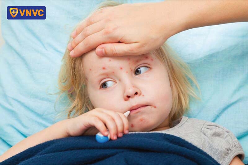chăm sóc trẻ bị bệnh sởi