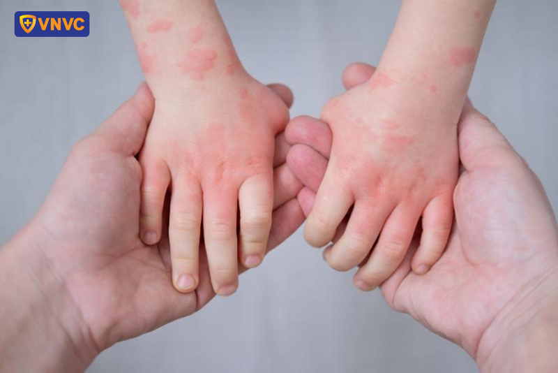 Nhấn vào ảnh để phóng to trẻ mắc bệnh tay chân miệng
