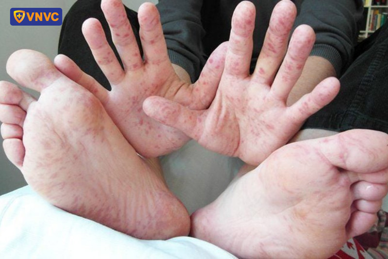 triệu chứng tay chân miệng ở trẻ em