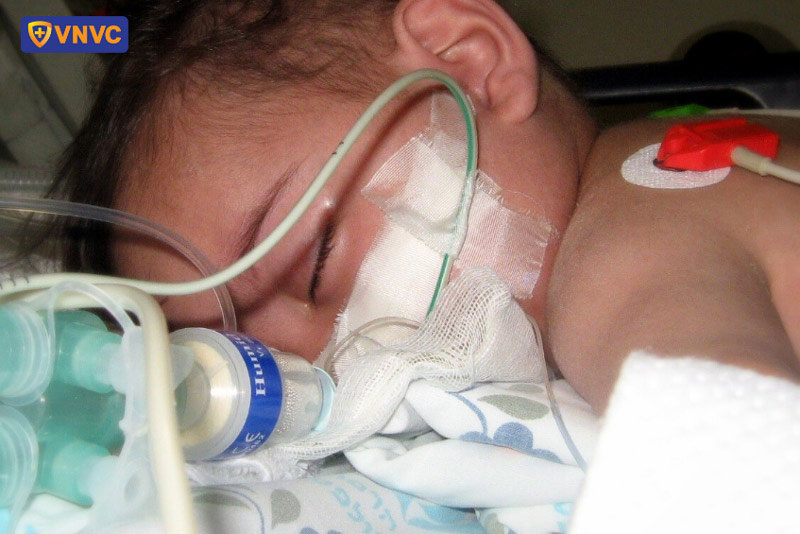 bé trai bị viêm màng não mủ