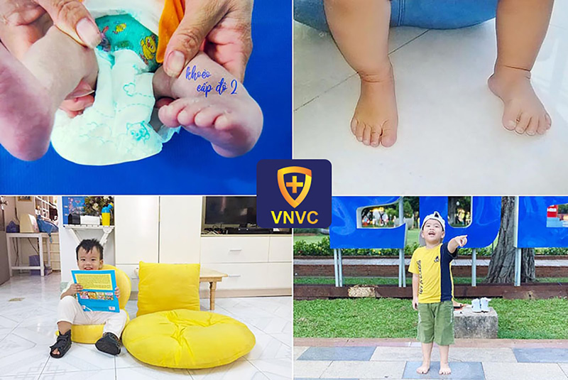 dị tật xương khớp ở trẻ