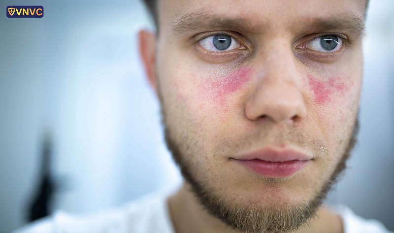 phát ban do Lupus ban đỏ