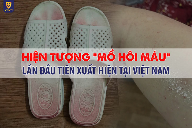 mồ hôi máu