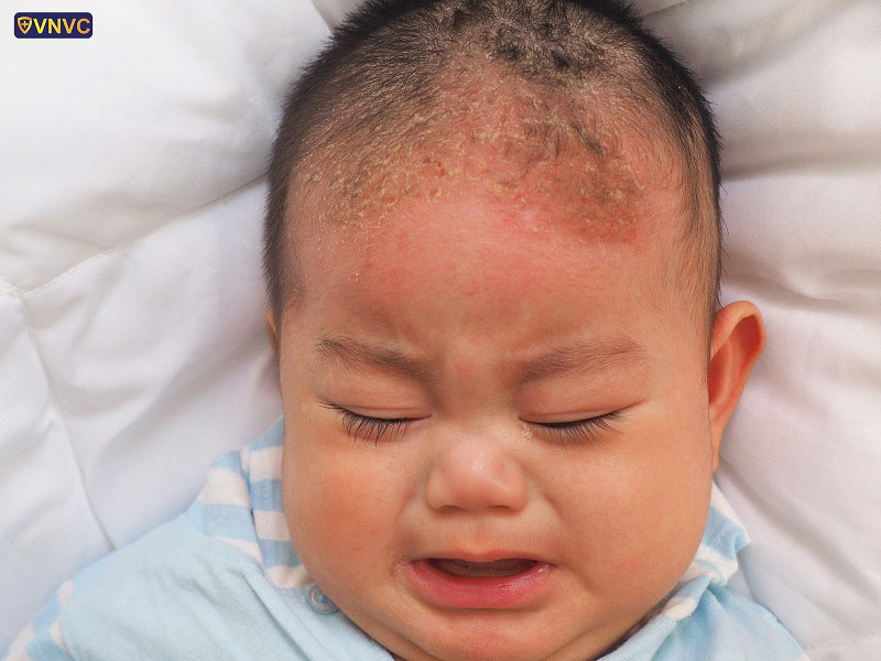 viêm da tiết bã ở trẻ