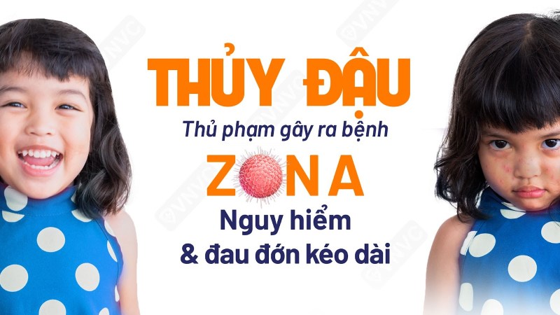 bệnh thủy đậu và vaccine