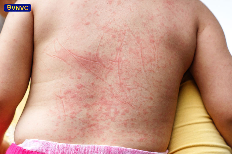 nhiem sot xuat huyet