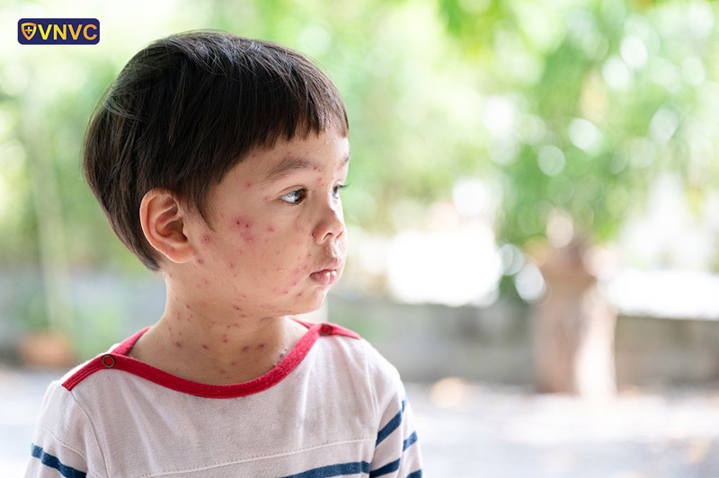 Nhấn vào ảnh để phóng to trieu chung dau mua khi