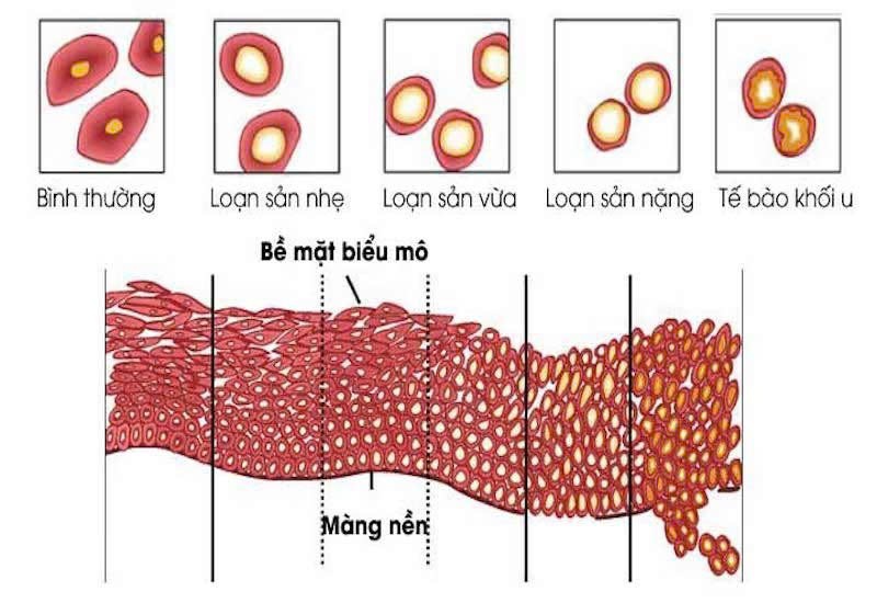 loạn sản cổ tử cung