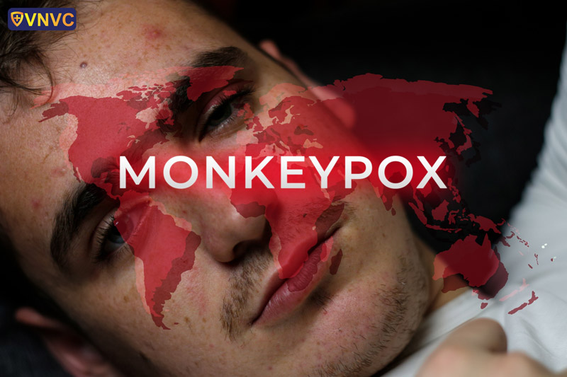 bệnh đậu mùa khỉ