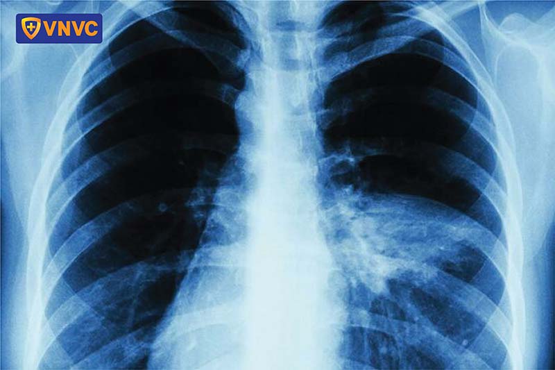 bệnh thủy đậu gây biến chứng viêm phổi