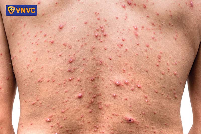 bệnh thủy đậu nặng ở người lớn