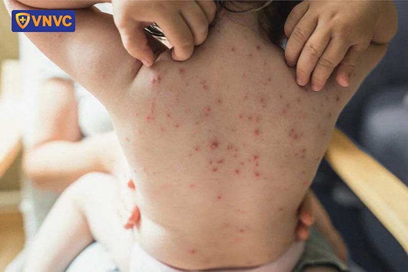 bệnh thủy đậu trên da của bé