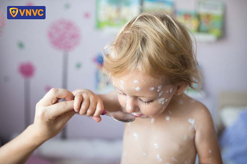 bôi kem dưỡng da khi bị thủy đậu cho bé