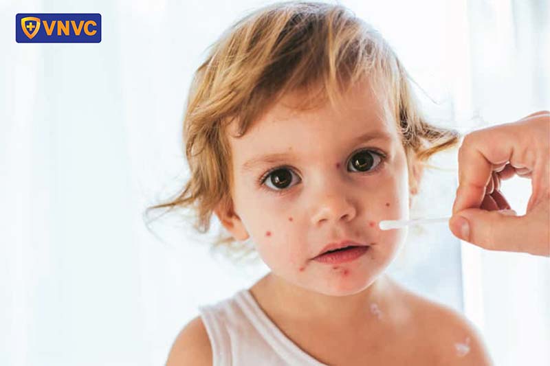 bôi thuốc hạn chế sẹo cho bé