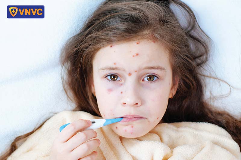 đo nhiệt độ sốt cho bé bị thủy đậu