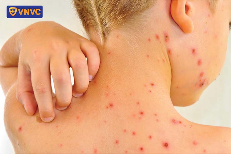 nốt thủy đậu trên cơ thể của trẻ em