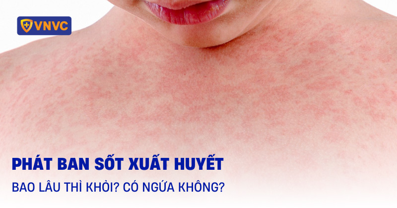 phát ban sốt xuất huyết