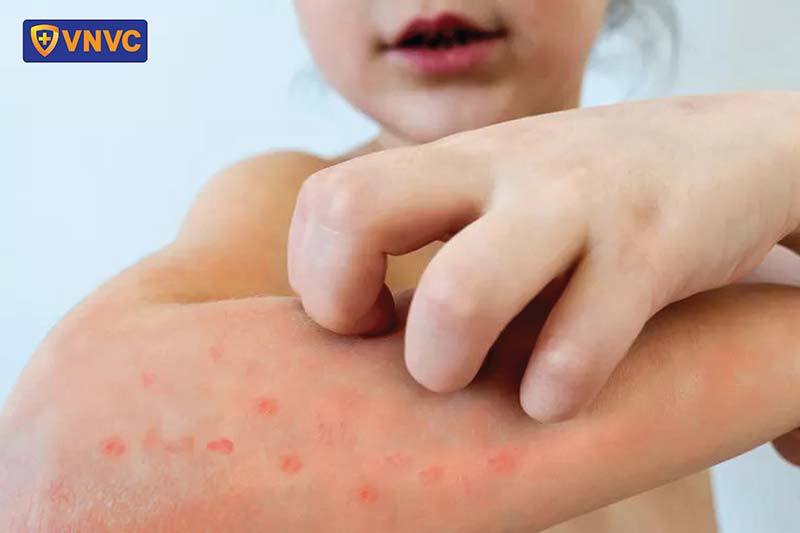 bé bị mắc bệnh thủy đậu