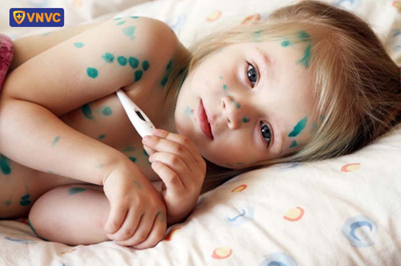 bé bị sốt khi bị thủy đậu