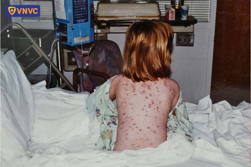 bé bị thủy đậu nặng
