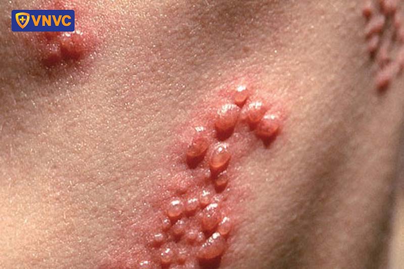 bệnh zona là biến chứng của thủy đậu