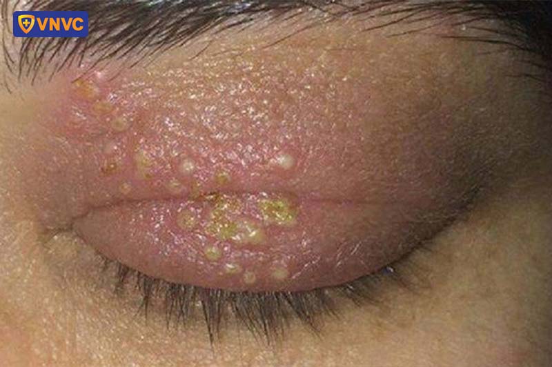 bị giời leo ở mắt