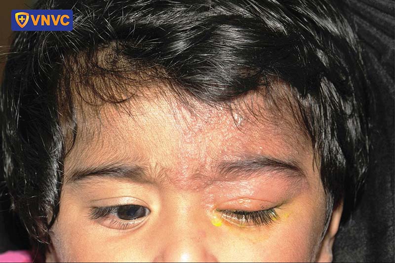 biến chứng zona thần kinh mắt