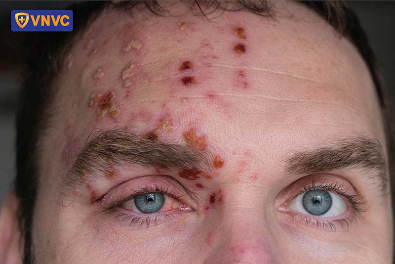 biểu hiện zona thần kinh ở mắt