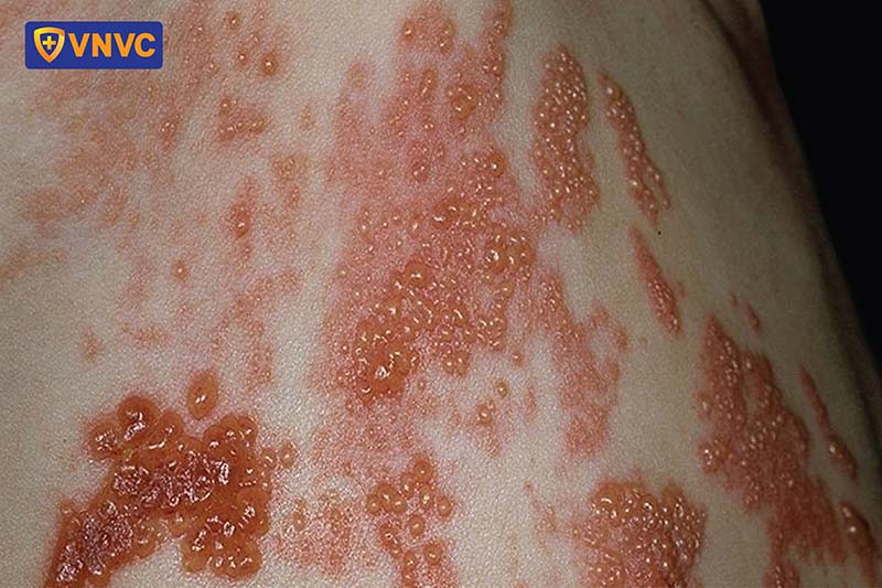 bội nhiễm zona thần kinh