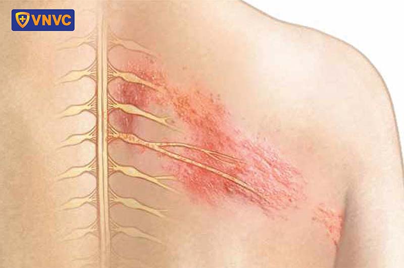 dấu hiệu bệnh zona thần kinh