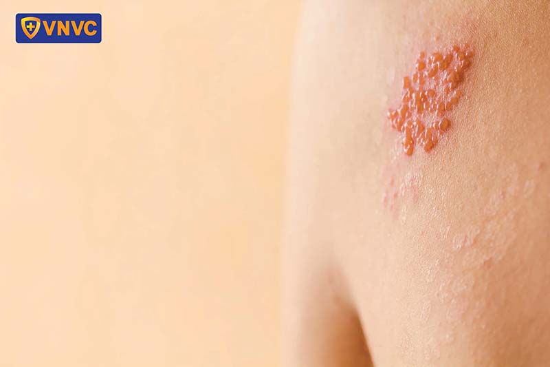 dấu hiệu zona thần kinh tái phát