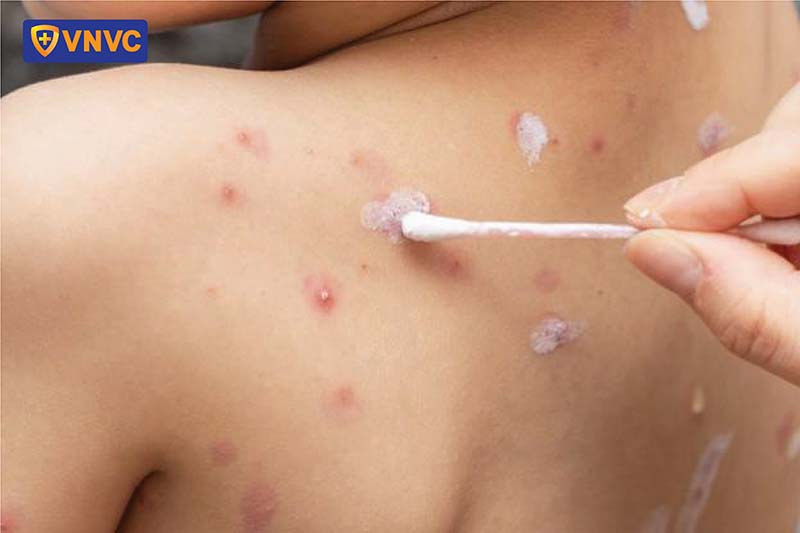 điều trị zona bội nhiễm