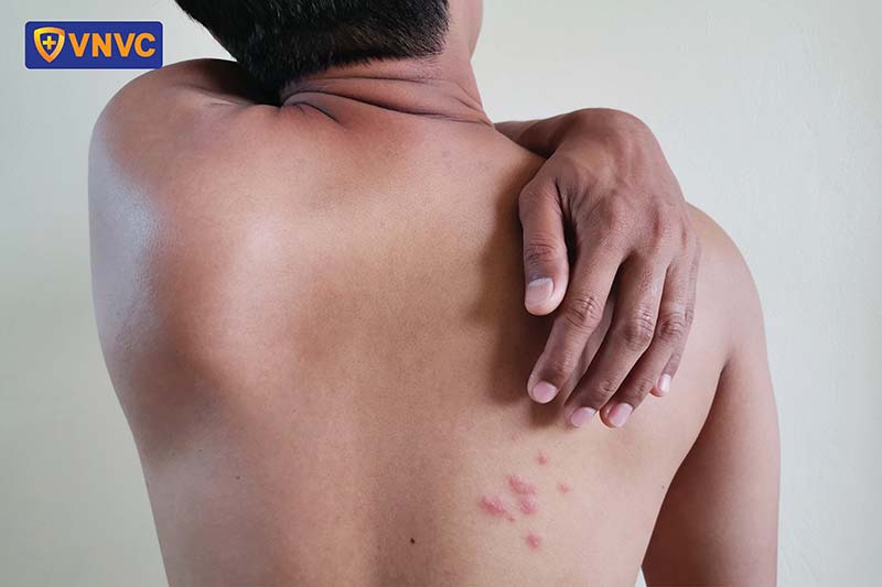 hình ảnh bệnh thủy đậu ở người lớn