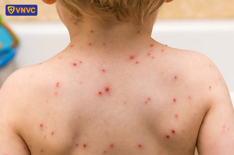hình ảnh bệnh thủy đậu ở trẻ em