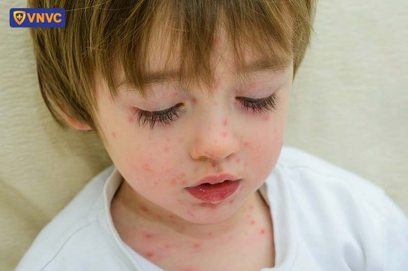 hình ảnh bệnh thủy đậu ở trẻ em