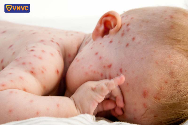 hình ảnh bệnh thủy đậu ở trẻ em