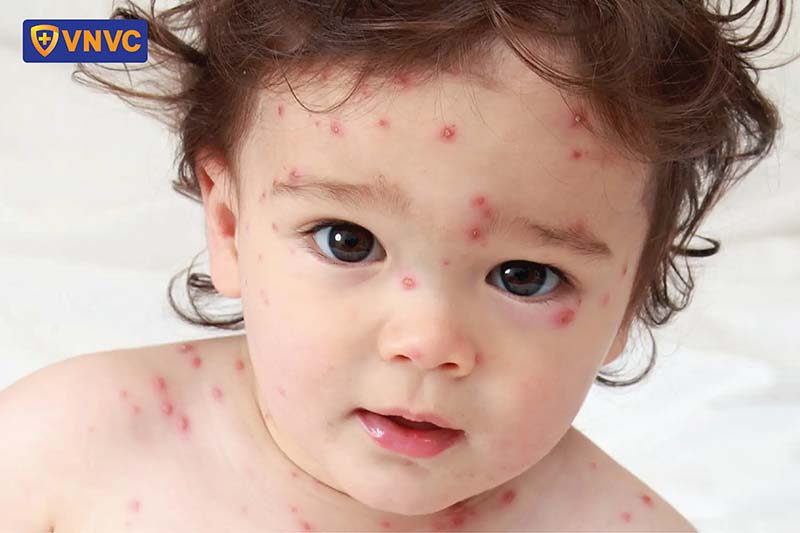 hình ảnh bệnh thủy đậu ở trẻ sơ sinh