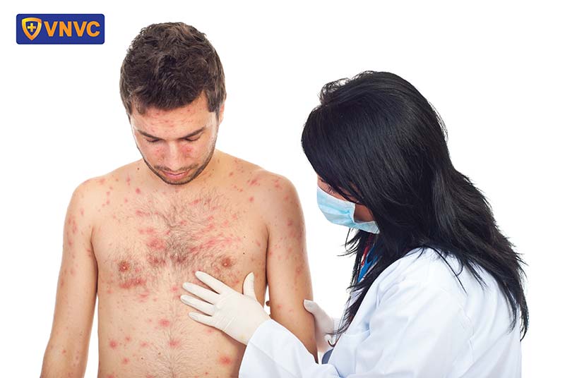 khám bệnh thủy đậu