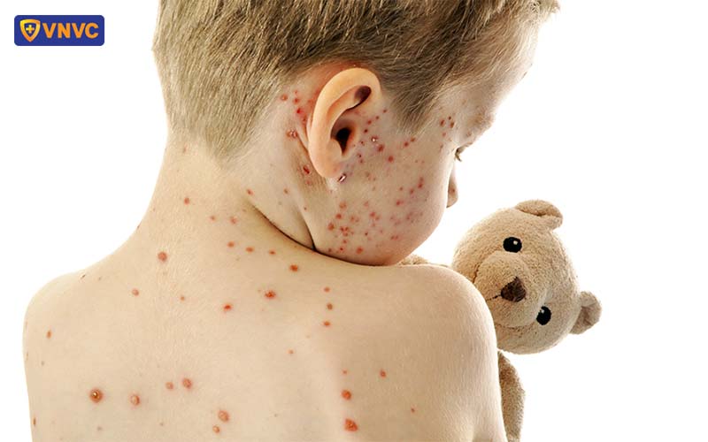 mụn nước thủy đậu trên người trẻ em