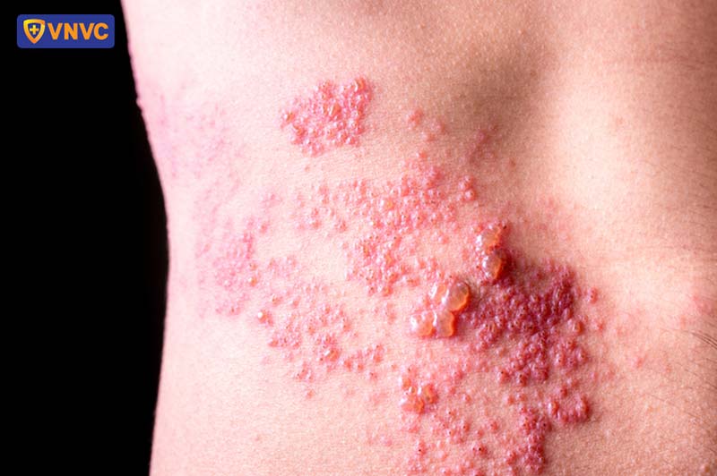 mụn nước zona thần kinh