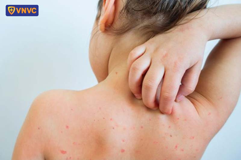 mụn thủy đậu gây ngứa khó chịu