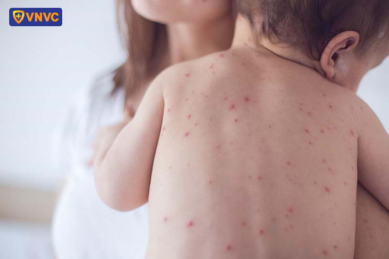 nốt thủy đậu ở trẻ em