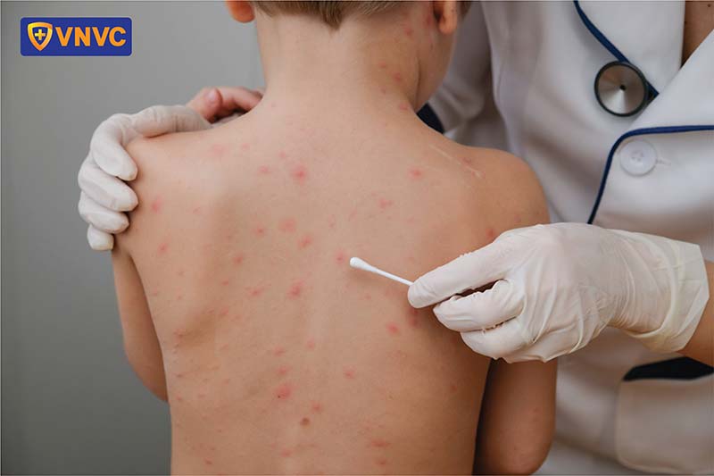 nốt thủy đậu trên người bé trai