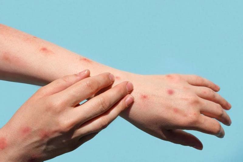 nốt thủy đậu trên tay người bệnh