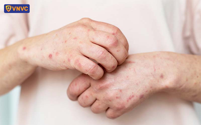 nốt thủy đậu trên tay người bệnh