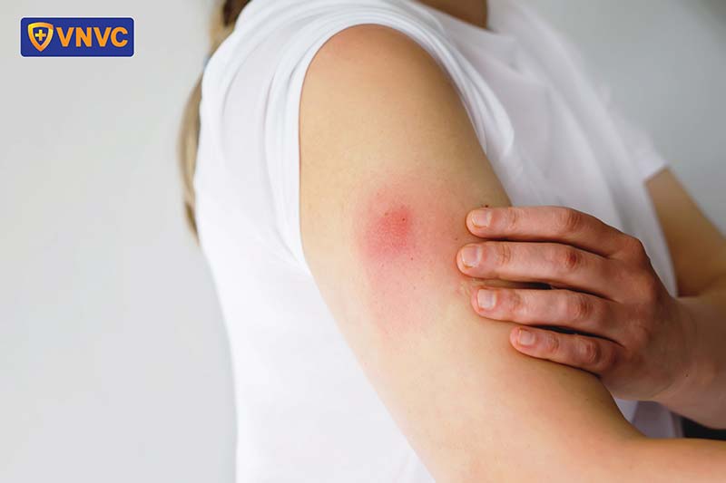 sưng đỏ chỗ tiêm vắc xin thủy đậu