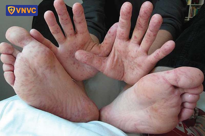 thủy đậu ở lòng bàn tay bàn chân