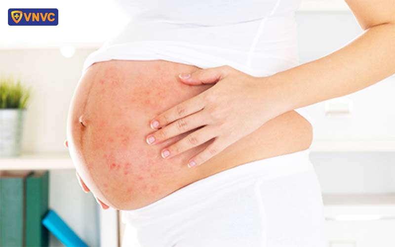 thủy đậu ở phụ nữ mang thai nguy hiểm