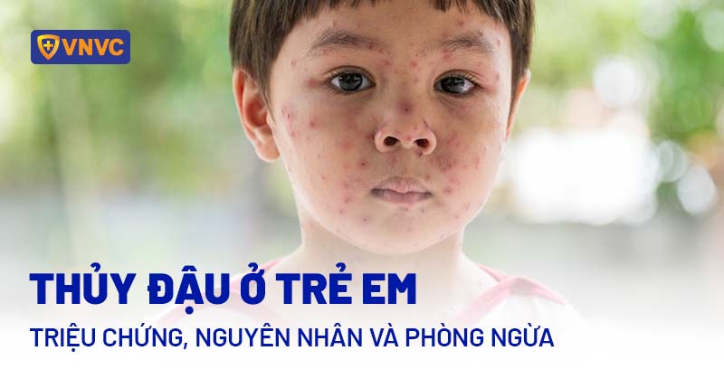 Nhấn vào ảnh để phóng to bệnh thủy đậu ở trẻ em
