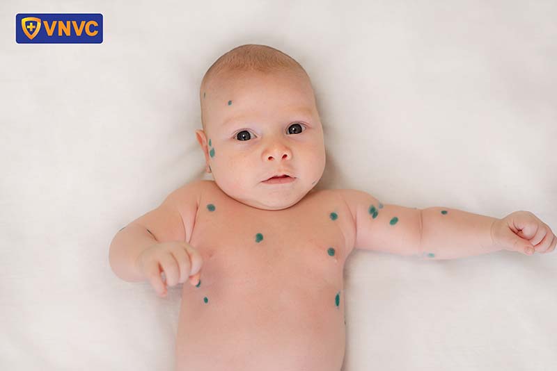 trẻ sơ sinh mắc thủy đậu